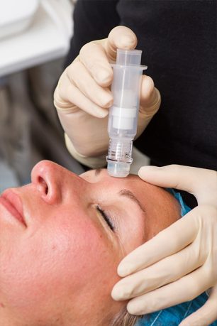 services-microneedling_