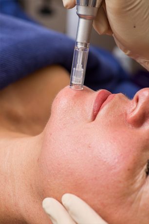 services-microneedling_2
